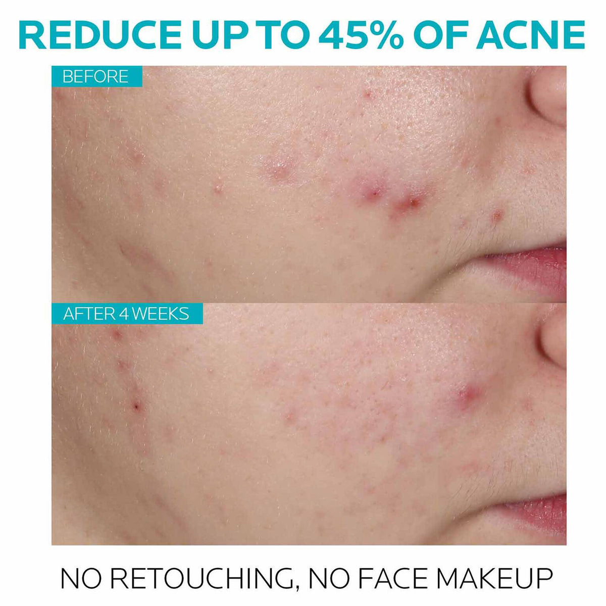effaclar-salicylic-acid-acne-treatment-serum-q3 7_EffaclarSerum_After-45-days.jpg 7_EffaclarSerum_After-45-days_861b20986157.jpg