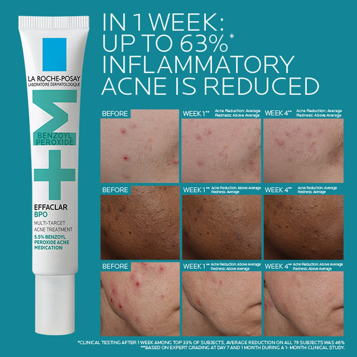 effaclar-bpo-multi-target-acne-treatment-with-5-5-benzoyl-peroxide-u0 EffaclarBPO-ClinicalBA-ATF-1500x1500-2.jpg EffaclarBPO-ClinicalBA-ATF-1500x1500-2_24504e8de09c.jpg